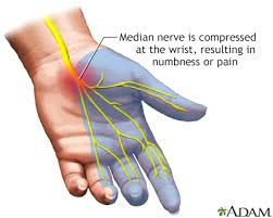 Carpal Tunnel Syndrome Symptoms, Causes & Treatments